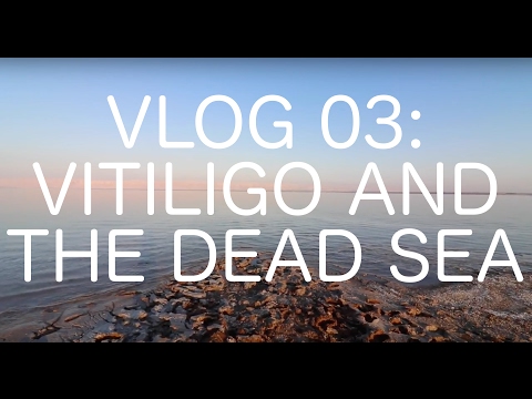 Simons Vitiligo Blog