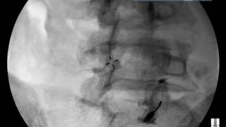 Lumbar Facet injection under Fluoroscopy - ThePainSource.com