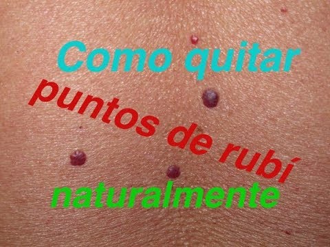 nevus rubi en bebes