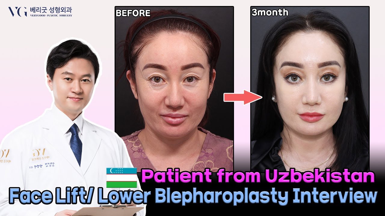 facelifts Korean facelift surgery! Very good plastic surgery YouTube