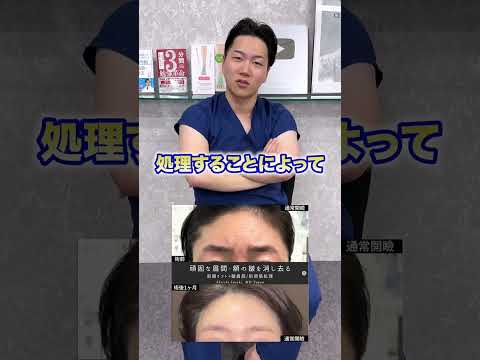 ボトックスが効かない眉間・額のシワに#shorts