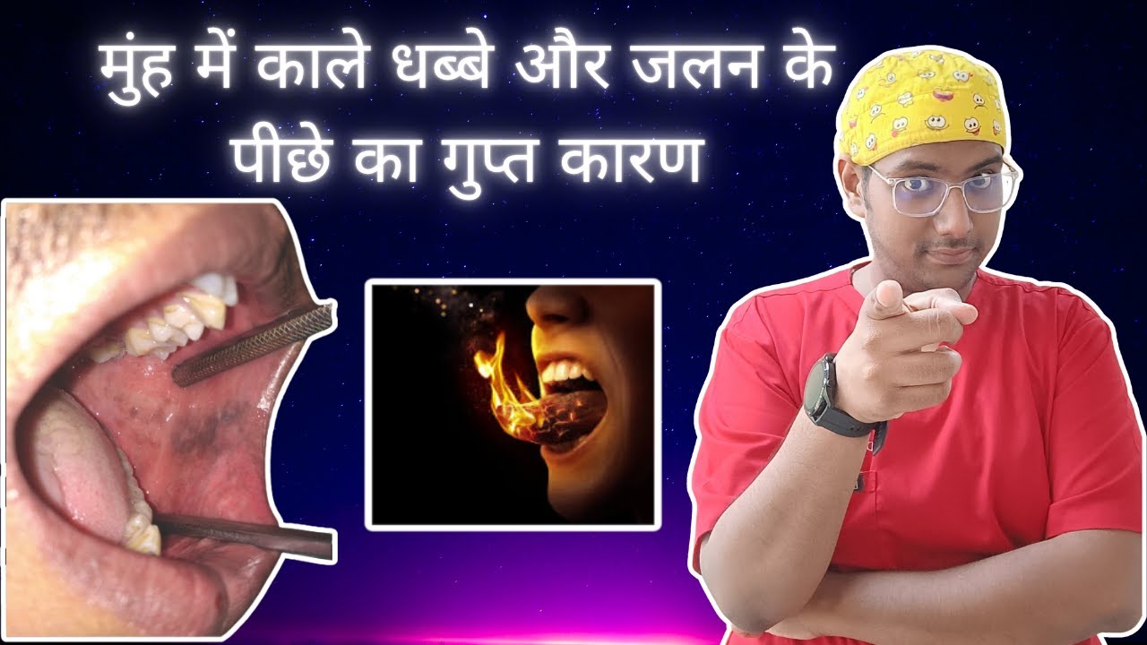 Dr Rudra Mohan | मुंह में काले धब्बे और जलन के पीछे का गुप्त कारण | Kaale Dhabbe aur muh ki Jalan