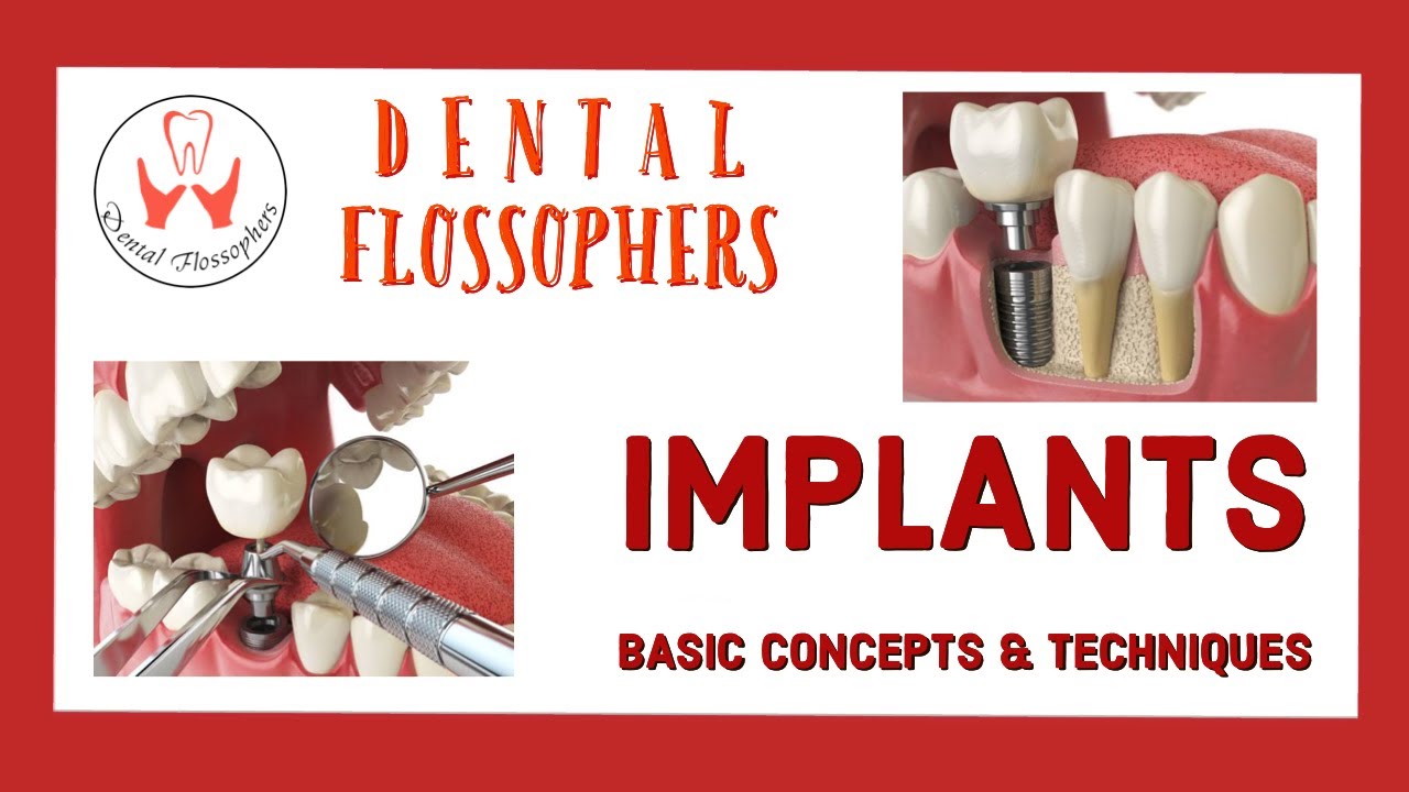 IMPLANTS BASIC CONCEPTS TECHNIQUES PARTS COMPLICATIONS
