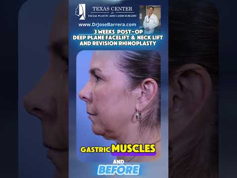 Video thumbnail: 3 Weeks Post-Op Testimonial Deep Plane Facelift, Neck Lift, and Revision Rhinoplasty. · Dr. Jose Barrera