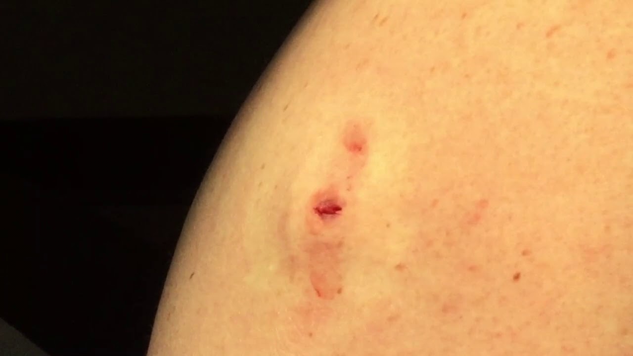 Cyst excision of back 8/23/2017 - YouTube