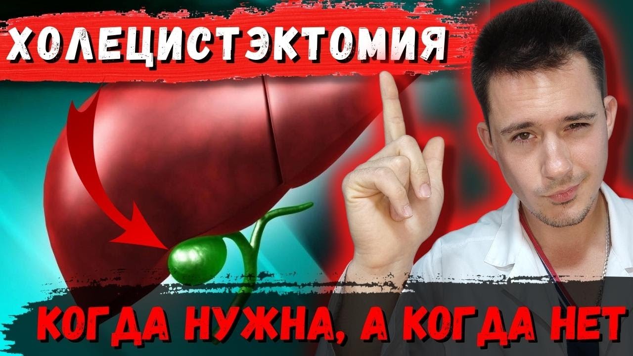 Желчекаменная болезнь. Холецистит | Операция холецистэктомия - YouTube