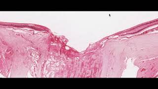 Eye pathology - Glaucoma