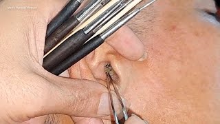 Telinga kotor || Cara membersihkan kotoran telinga yang kering