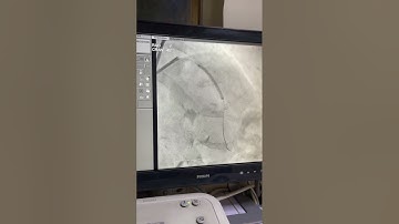 Complex PCI of highly Calcified vessel #pci  #angioplasty  #angiography #trending v#cardiology