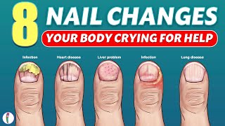 Nail signs of Disease | Nail pitting | Finger clubbing | Signs of anemia | Terry's nails screenshot 3