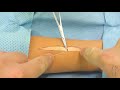 Hemostasis technique in a wound / Ligation around hemostatic clamp / Гемостаз с помощью лигатуры