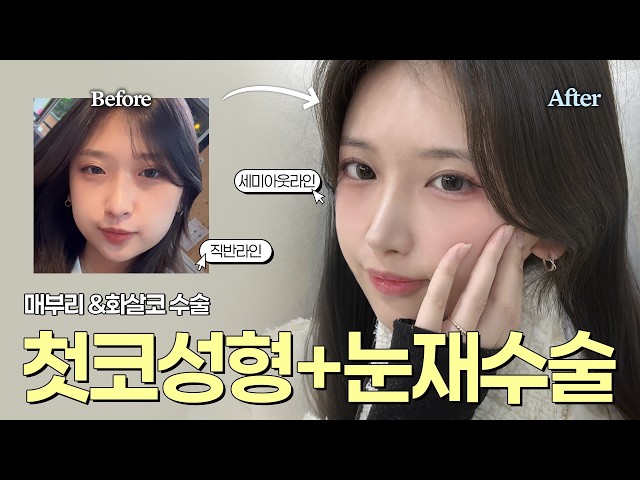 눈코성형 한번에 하고 존예됨🧡 |  쌍꺼풀 재수술 & 첫 코성형 6개월 차 후기