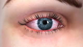 Meibomian Gland Dysfunction And Dry Eye