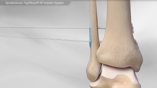 Syndesmosis TightRope® XP Implant System