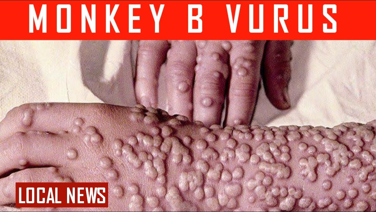 monkey B virus | monkeypox | local news - YouTube