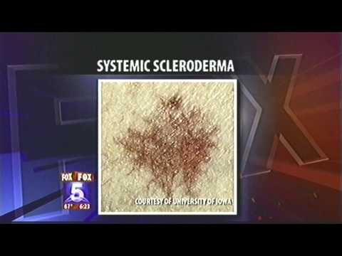 What Is Scleroderma? | San Diego Dermatology | Dr. Goldman