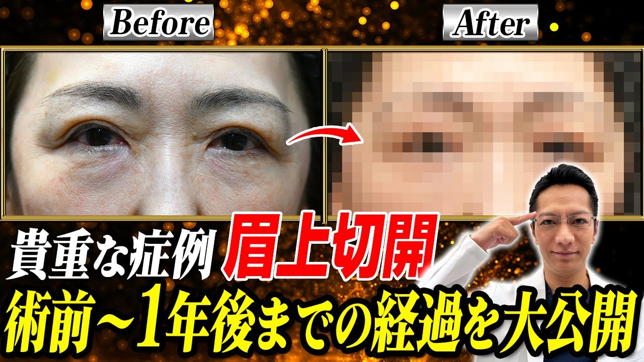 【レア手術】60代女性の眉上切開（ブローリフト）症例紹介！ダウンタイムや傷跡、術後1年の経過を大公開【若返り整形】