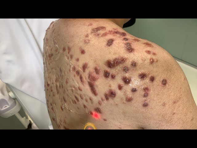 Can monkeypox cause keloid scars?