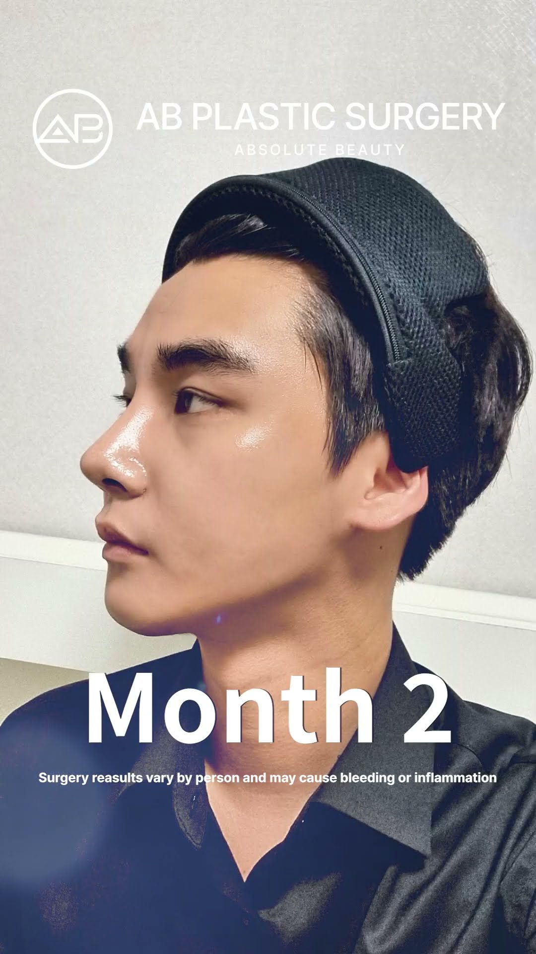 From Ordinary to Sharp His Nose Transformation Will Amaze You #shorts