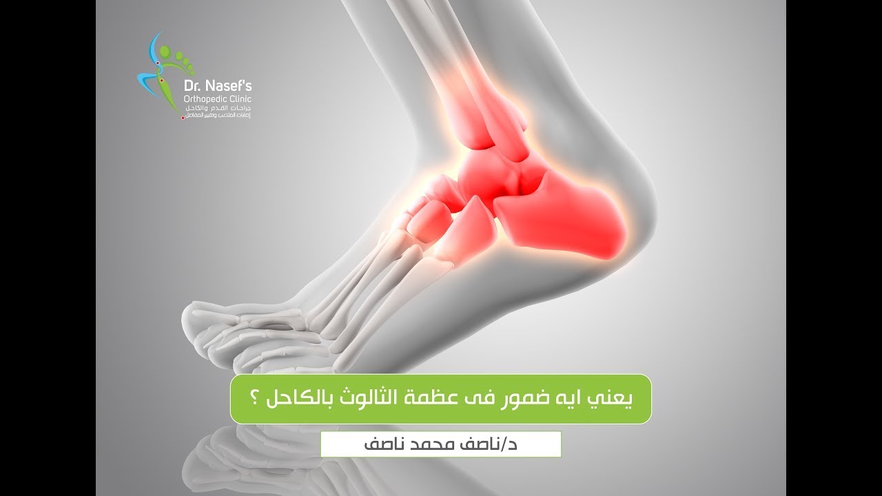 يعني ايه ضمور فى عظمة الثالوث بالكاحل ؟ | ضمور عظمة الثالوث بالكاحل | تآكل عظمة الثالوث
