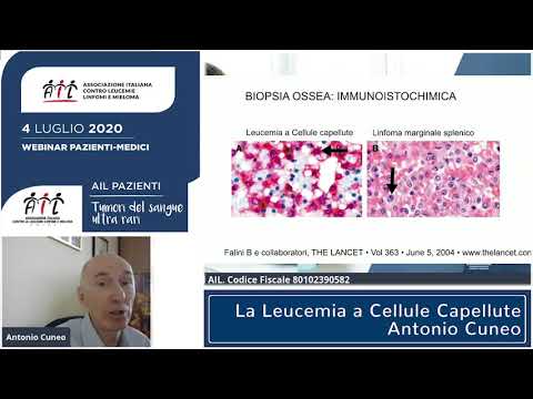 La Leucemia a Cellule Capellute - Antonio Cuneo