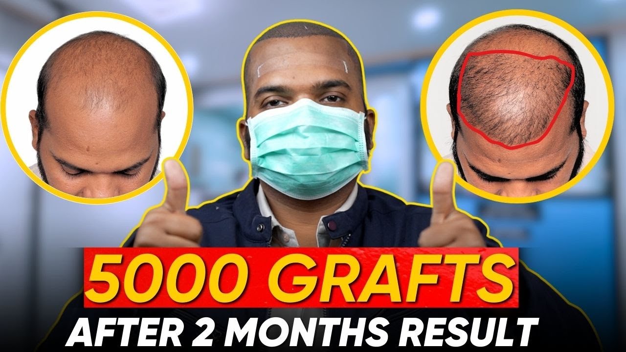 Hair Transplant in Muzaffarpur Best Results & Cost of Hair Transplant