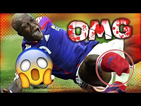 הפציעות הכי כואבות בכדורגל העולמי (מפחיד)