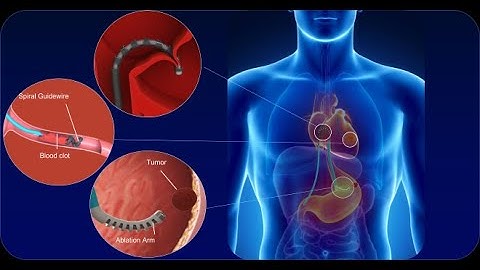 Bidirectional Bending Soft Robotic Catheter with for Minimally Invasive Surgery