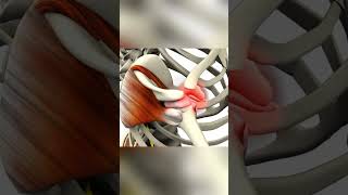 What Is Bursitis