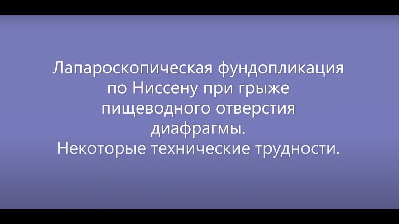 Лапароскопическая фундопликация по Ниссену при грыже пищеводного ...