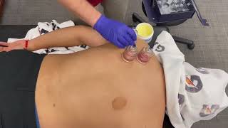 Cupping the Scapula