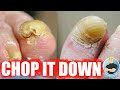 SUPER THICK TOENAIL TRIMMING SATISFACTION