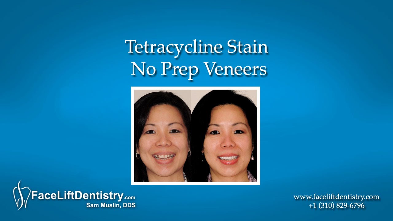 Tetracycline Stain – No Prep Veneers cosmetic dentistry grants program