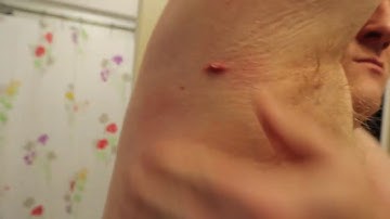 Pimple Behind Armpit