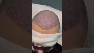 No Scars, Just Results 💫 Micro FUE Hair Transplant | Dr. Salman