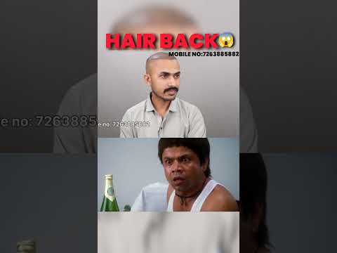 Hair transplant results #shorts