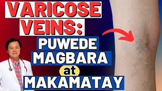 Varicose Veins: Pwede Magbara at Makamatay. - By Doc Willie Ong (Internist and Cardiologist)