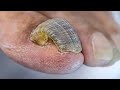 TRIMMING A CURLED, THICK TOENAIL ***BUFFING A DAMAGED NAIL***