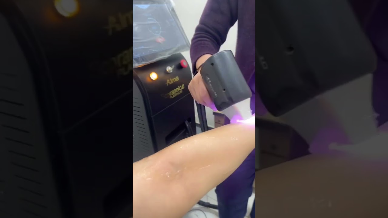 Laser hair removal 