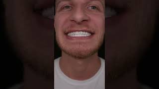 Download Lagu Smile Design Before After #shorts #smile #smiledesign MP3 Download Lagu Smile Design Before After #shorts #smile #smiledesign MP3