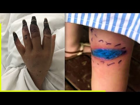 Mother Spots 'Blue Mark' On Her Daughter’s Leg – Rushes Her To Hospital After It Turns Black....