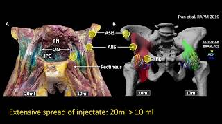 Pericapsular Nerve Group (PENG) block for hip analgesia