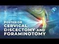 What is Endoscopic Posterior Cervical Discectomy and Foraminotomy?
