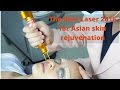 Best Laser for Asian Skin Rejuvenation