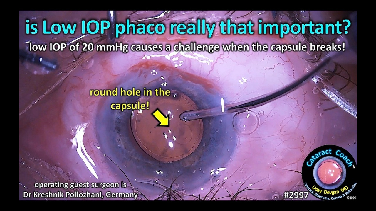 Low IOP Phacoemulsification Risks