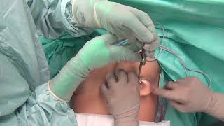 عمل پروتز سینه - جراحی پروتز سینه یا برجسته کردن سینه - زیبایی سنتر