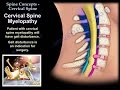 cervical myelopathy and cervical radiculopathy- Everything You Need To Know - Dr. Nabil Ebraheim