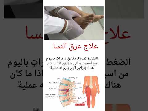 علاج عرق النسا بشكل طبيعي وبدون جراحه