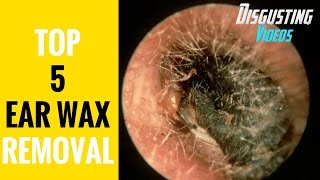 TOP 5 MASSIVE EAR WAX EXTRACTION - EAR WAX REMOVAL 2017 HD