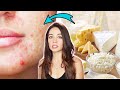Nutritionists Reveal Which Foods Affect Your Acne
